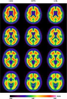 Absence of Relationship Between Self-Reported Sleep Measures and Amyloid Load in Elderly Subjects